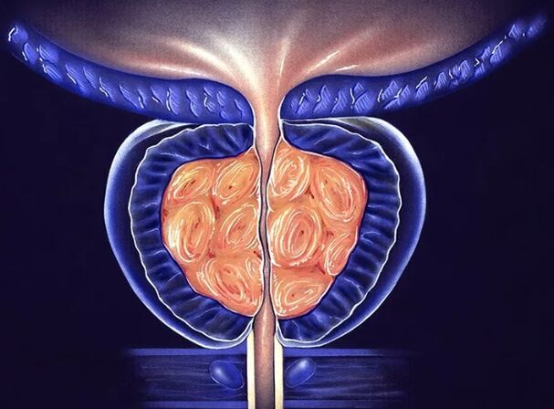 Chronische bakterielle Prostatitis bei Männern